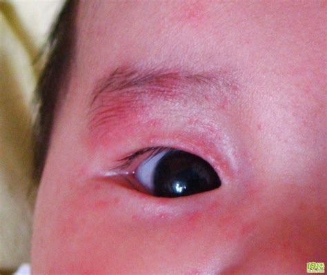 过敏眼睛痒怎么办缓解（过敏季节眼睛痒，太难受？不要急，弄清原因，对症治疗，很简单） | 说明书网