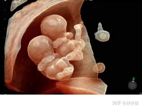 连载（二十）|圆圈妈双胞胎怀孕过程第23周 - 知乎