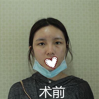 上海九院的孙宝珊做脸部填充怎么样？附真人手术过程实拍图-欣美整形网