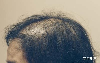 斑秃知道这几点原因，很快就能治好长出头发 - 知乎