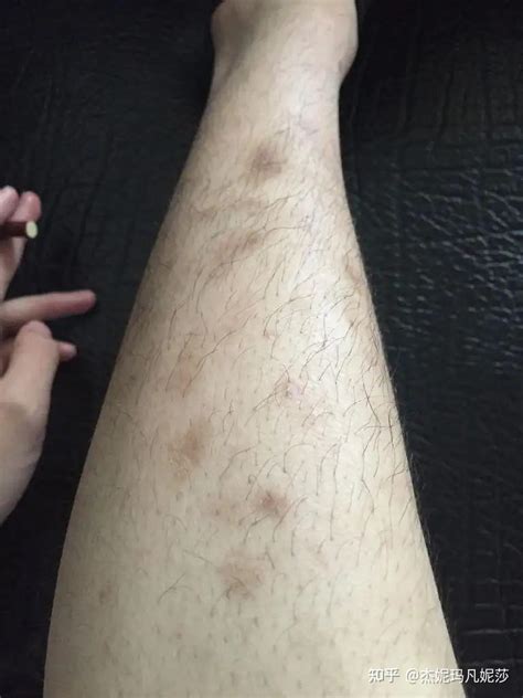 小腿长局部散块红点是什么皮肤病_百度知道