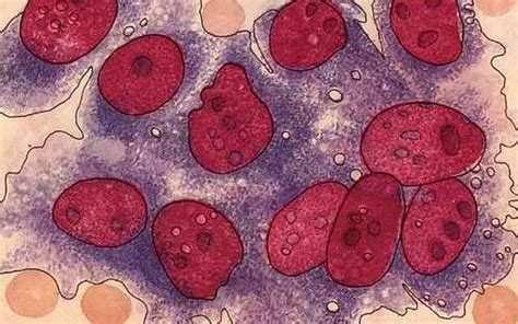 尽早启动抗病毒治疗降低慢性HBV感染者肝细胞癌发生风险