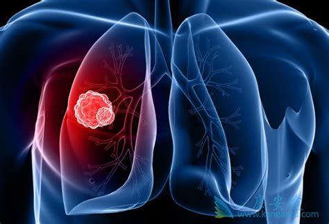 小细胞肺癌晚期症状和死前征兆-有来医生