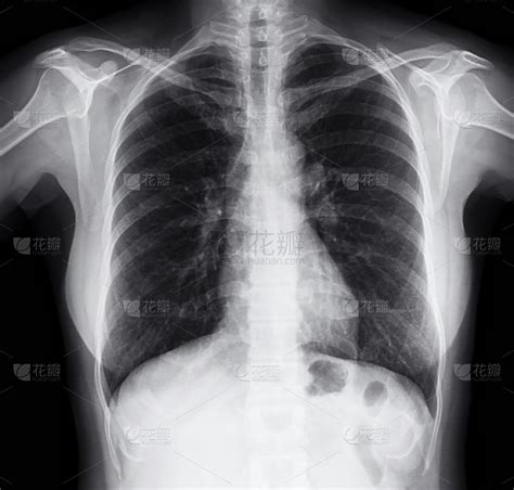 胸部,x光片,女人,射线成像,胸腔,x光,医学扫描仪器,动脉硬化症,放射科专家,高血压