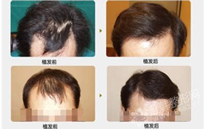 北京世熙整形医院植发科头发种植有哪些特点呢 有后遗症吗_贝贝整形网