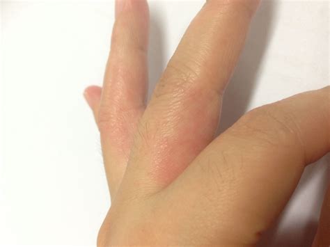 手指水泡型湿疹图片 (3)_有来医生