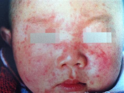 【图】红斑丘疹图片分析 教你识别红斑和丘疹的各种症状(3)_伊秀美容网|yxlady.com