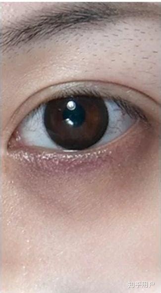 孩子有黑眼圈是什么原因 儿童如何预防黑眼圈 _八宝网