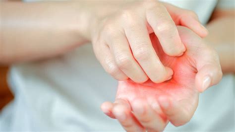 手指小水泡的治疗过程（真实经验）-百度经验
