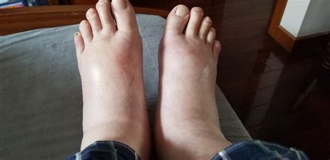 脚底干燥脱皮开裂是什么原因(脚后跟经常起皮开裂，是缺乏维生素吗？原因不止一种，对照检查) - 【爱喜匠】