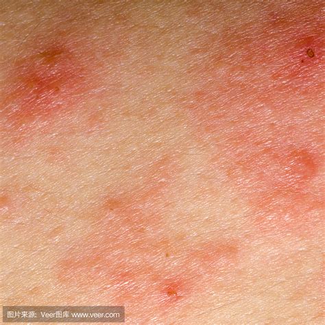 过敏性皮炎图片和症状，表现为湿疹/荨麻疹/各种皮炎(红肿瘙痒) — 神奇养生网