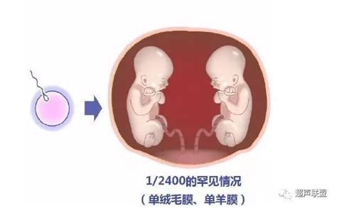 孕21周单绒双羊双胞胎发育有差距会是双胎输血症吗?_家庭医生在线