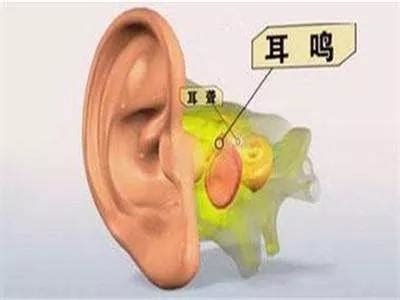 如何用针灸治疗耳鸣？-基层医生网