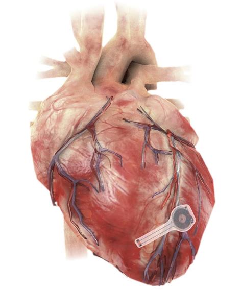 美国科学家发明世界首款可溶解无线心脏起搏器_新浪图片
