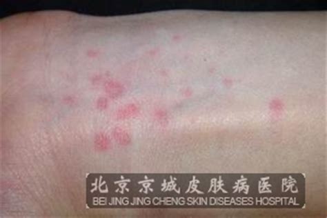 寻常性荨麻疹的主要症状有哪些_荨麻疹_北京京城皮肤医院(北京医保定点机构)