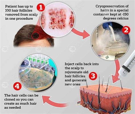 韩国治疗脱发的新毛囊克隆技术进展如何？ - 前沿技术 - 毛毛网