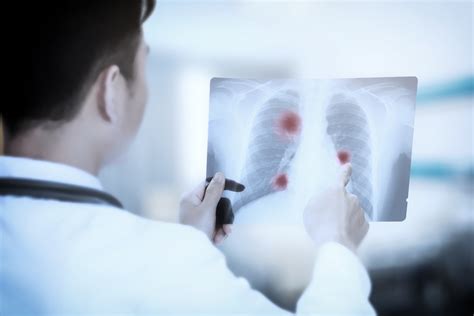 周围型肺癌的影像学表现-肺癌诊断-复禾健康