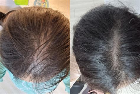 发缝越来越宽，不要担心，这个方法助你重新长出头发 - 知乎