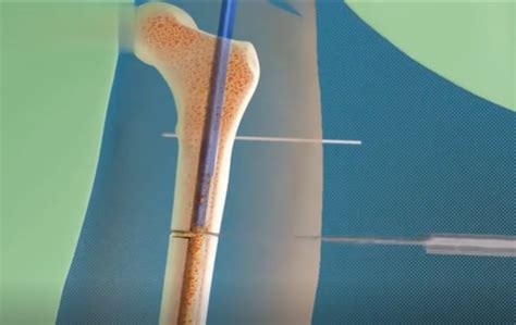 3D医学动画|告诉你增高手术的原理 – 肽度TIMEDOO