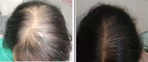 【图】头发稀疏的治疗方法有哪些 小窍门助你早日解决脱发问题(3)_头发稀疏的治疗方法_伊秀美容网|yxlady.com