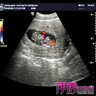【怎么看b超图】【图】怀孕了怎么看b超图 B超单告诉你宝宝的性别(3)_伊秀健康|yxlady.com