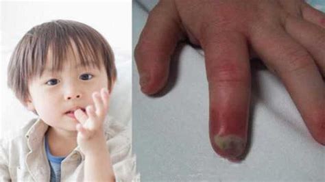 为什么很多孩子都喜欢咬指甲，有哪些危害？家长们要重视_腾讯视频