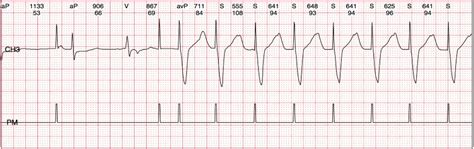一、心室按需型起搏(VVI)和心室频率应答型起搏(VVIR)-急救医学-医学