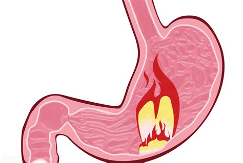 胃不舒服？学会分辨胃酸过多与过少的症状，及时治疗，少遭罪！|慢性胃炎|胃酸过多|胃酸_新浪新闻