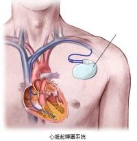 心脏起搏系统的构成、起搏器的类型及其表达方式_电极