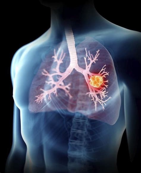 胸部CT看起来像是肺炎，最终确诊为肺癌！这种特殊肺癌易被误诊成肺炎-科普头条-看呼吸