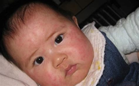 孩子面部出麻疹的严重图片_有来医生