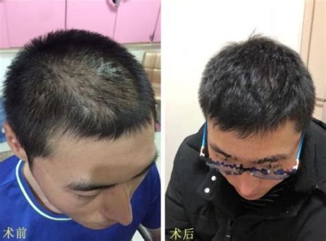 北京植发案例-种植头发-对比效果图-发友网