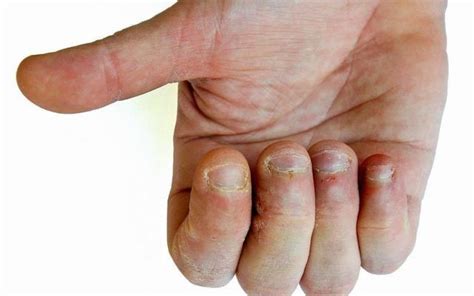 10岁男童啃指甲的坏处,小孩咬指甲有什么方法戒除?