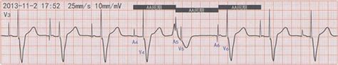 二、心室起搏时的室性融合波与假性室性融合波-临床起搏心电图-医学