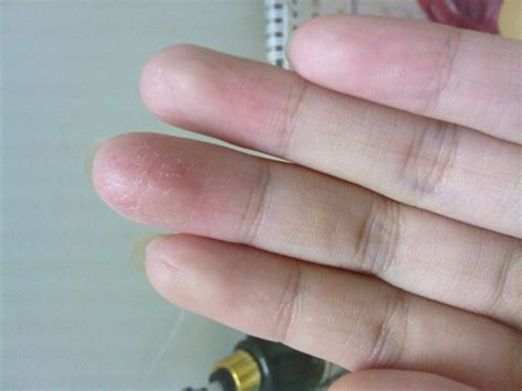 手指小水泡的治疗过程（真实经验）-百度经验