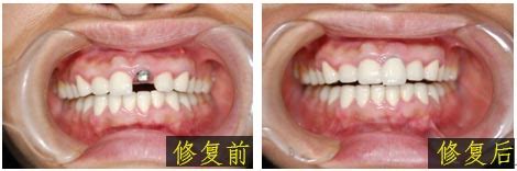 宁波“医保种植牙”单颗种植牙价格3500元封顶 - 看牙记网