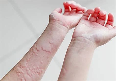 慢性和急性荨麻疹是什么原因引起的图片