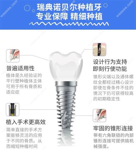 普通种植牙一颗牙多少钱,国产便宜种植牙4000+韩国便宜的3980+ - 口腔资讯 - 牙齿矫正网