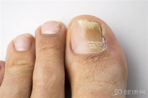 碘伏能治疗灰指甲吗？