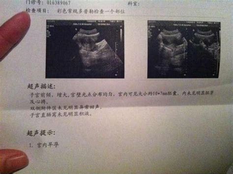 怀孕一个月b超能看到吗 怀孕一个月b超能看出来吗_第二人生