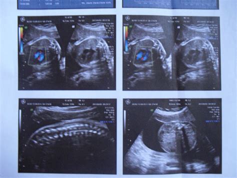 7个月彩超单看胎儿性别 - 百度宝宝知道