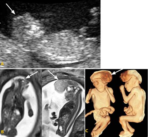 各种胎儿神经管畸形的超声与 MRI 特征 - 丁香园