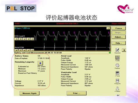 二、起搏标记通道-临床起搏心电图-医学