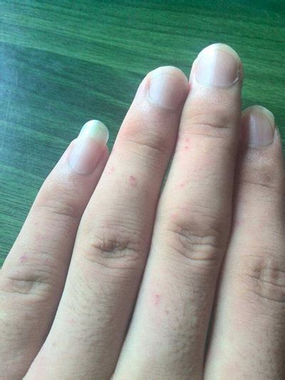 手指水泡型湿疹图片 (36)_有来医生