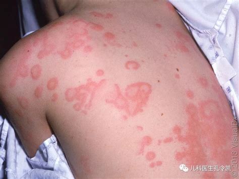 【荨麻疹会传染】【图】荨麻疹会传染吗 介绍预防的4大方法(2)_伊秀健康|yxlady.com