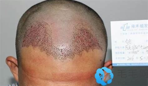 女性头发稀疏如何加密？北京新生植发有妙招_互联网_艾瑞网