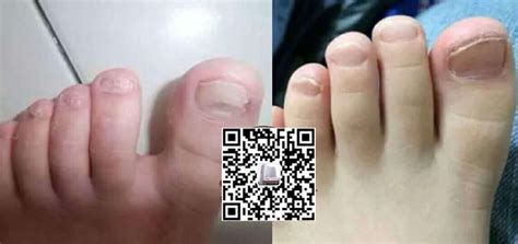 患病灰指甲的症状有哪些呢_甲癣_北京京城皮肤医院(北京医保定点机构)