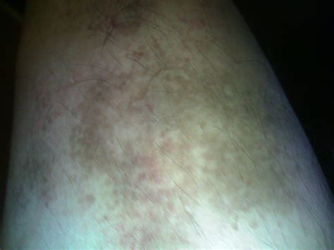 小腿长局部散块红点是什么皮肤病_百度知道