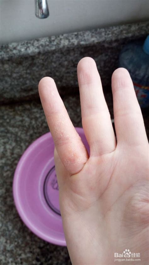 【手指起水泡发痒是怎么回事】【图】手指起水泡发痒是怎么回事 3个有效方法可以帮助你(2)_伊秀健康|yxlady.com