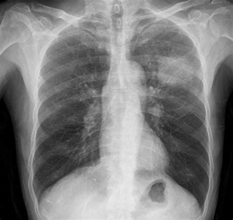 病例133 周围型肺癌(一)-临床影像诊断-医学